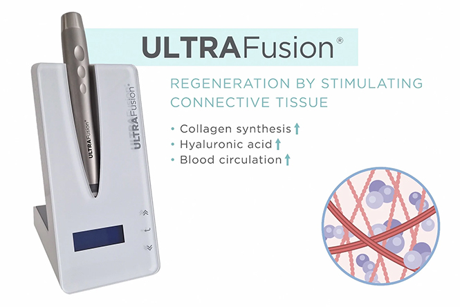 ultrafusion Lkn